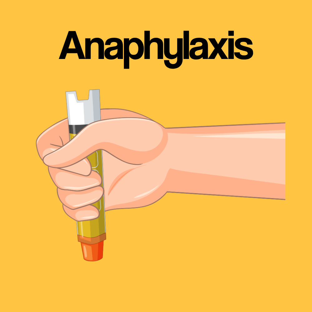 Guide by Condition: Anaphylaxis