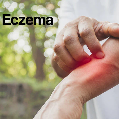 Guide by Condition: Eczema