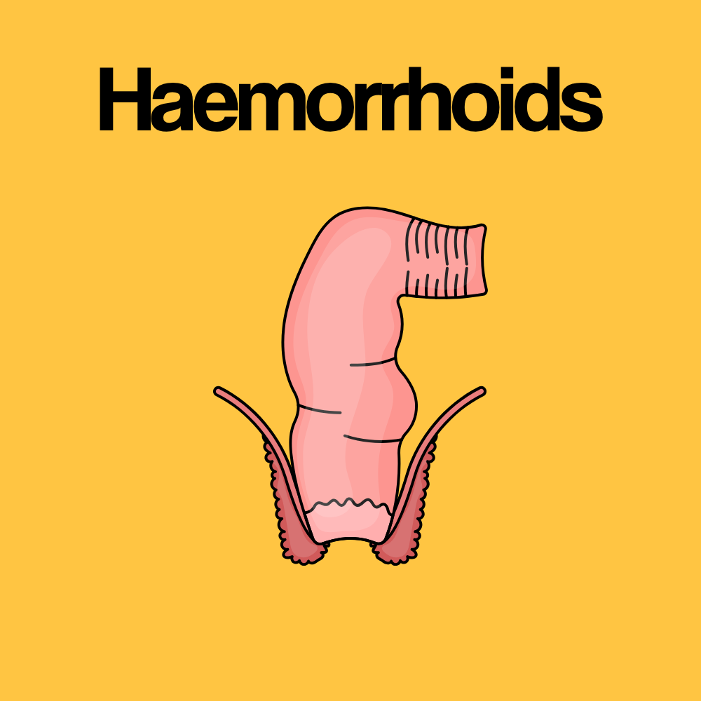 Guide by Condition: Haemorrhoids