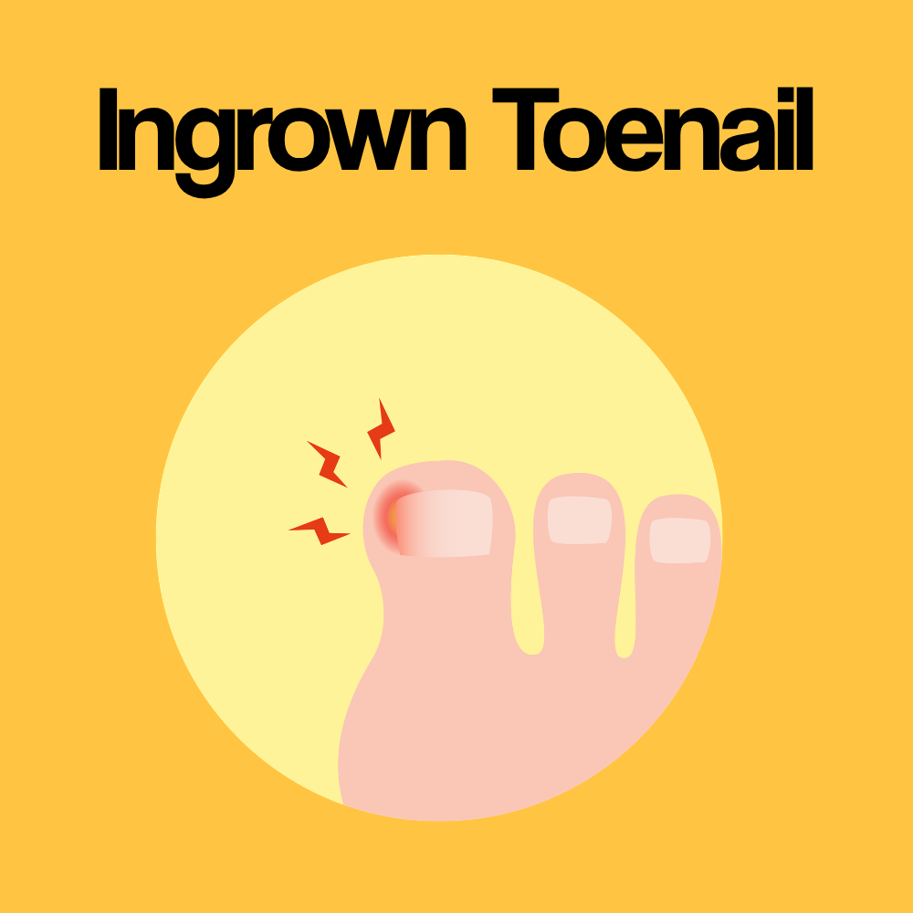 Guide by Condition: Ingrown Toenail