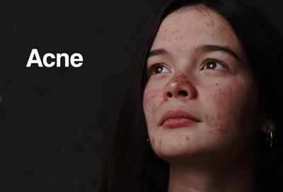 A picture of a woman's face that has a lot of acne on it. The background is black and has a white word on it saying – Acne