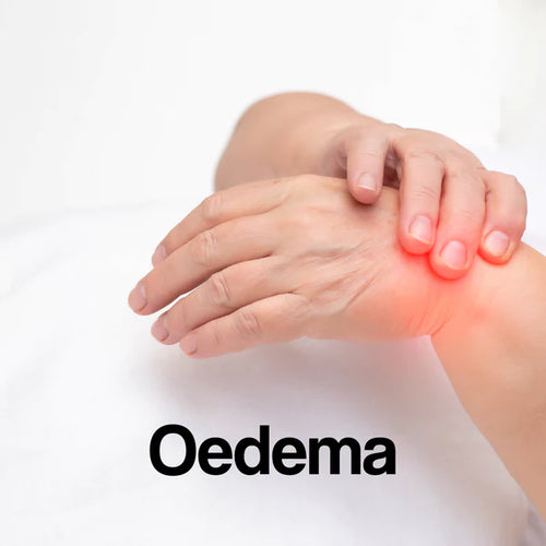 A white panel with the word – Oedema – on it