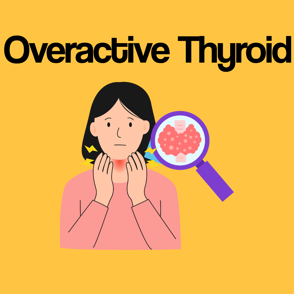 Guide by Condition: Overactive Thyroid