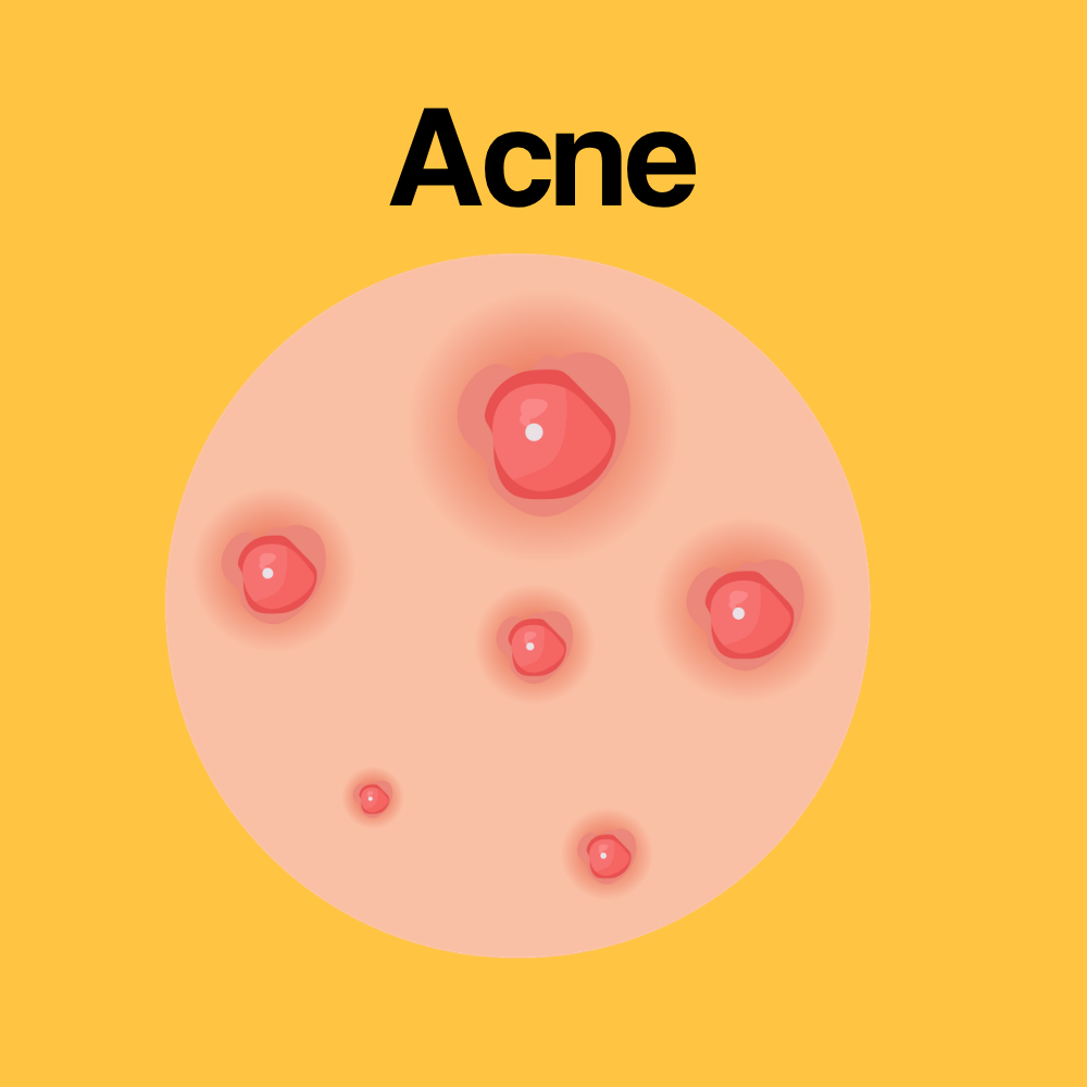 Guide by Condition: Acne