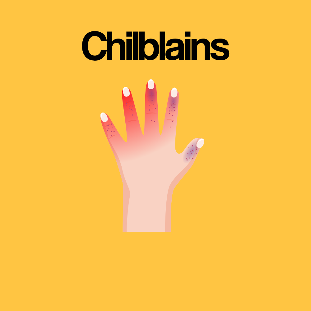 Guide by Condition: Chilblains