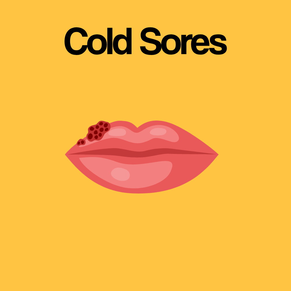 Guide by Condition: Cold Sores