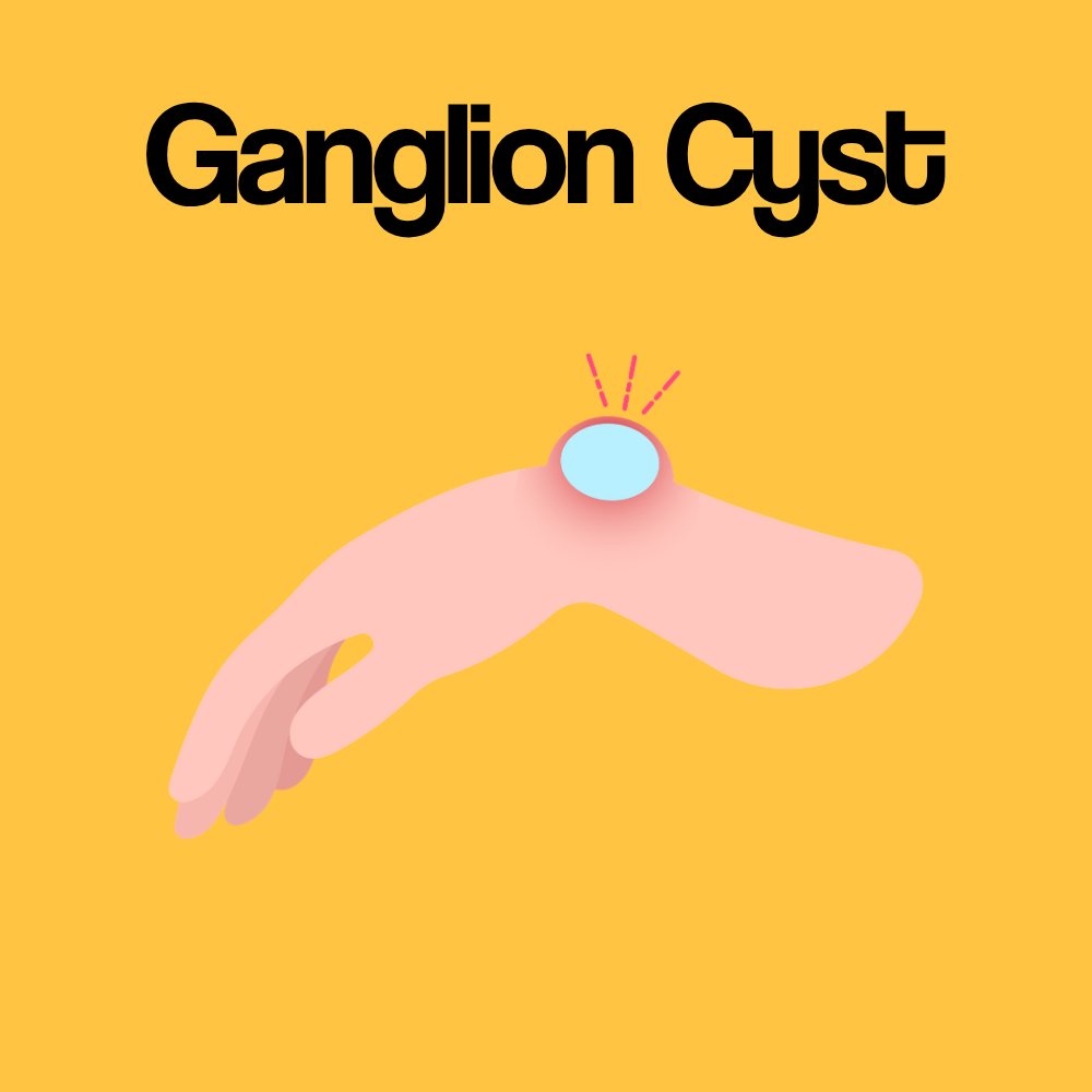 Guide by Condition: Ganglion Cyst