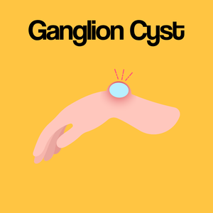 Guide by Condition: Ganglion Cyst