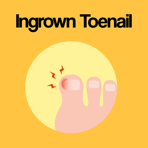 Guide by Condition: Ingrown Toenail