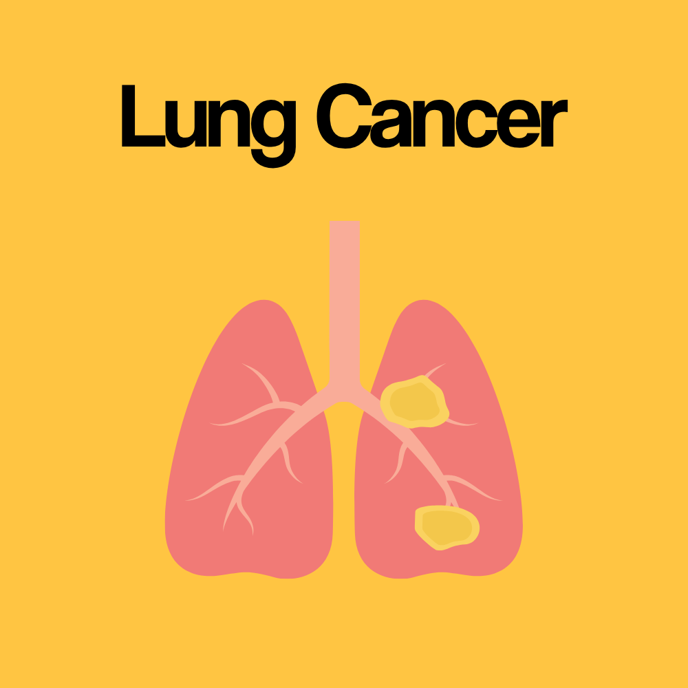 Guide by Condition: Lung Cancer
