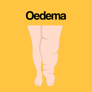 Guide by Condition: Oedema