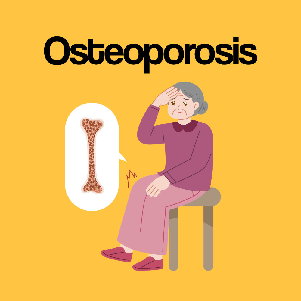 Guide by Condition: Osteoporosis