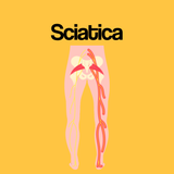 Guide by Condition: Sciatica