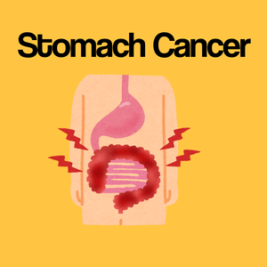 Guide by Condition: Stomach Cancer